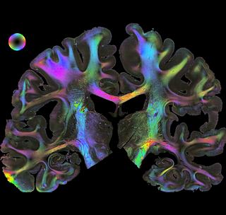 Today’s computers cannot yet create a simulation of an entire human brain, though that could help decisively improve our understanding of neurological diseases.  © © Forschungszentrum Jülich / Markus Axer A simulation of an entire human brain.