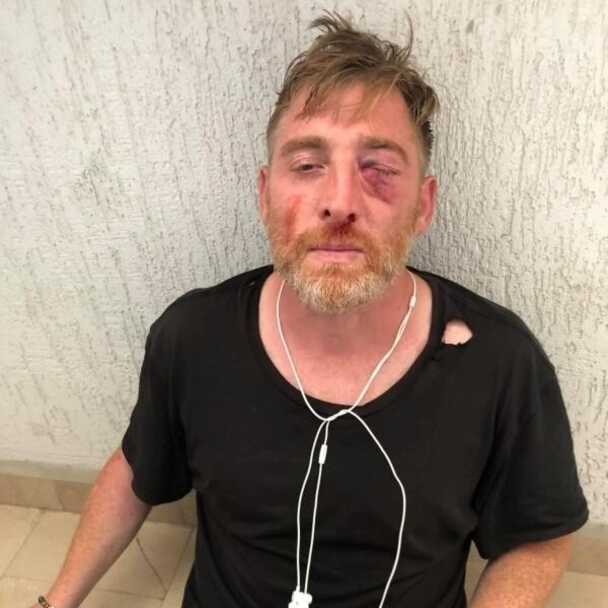 Journalist Lekso Lashakarava after the violent attacks at Tbilisi Pride 2021 (@Lashakarava)