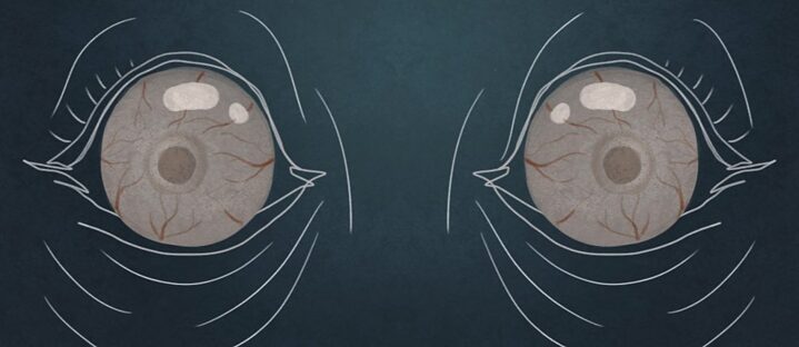 I do not sleep How did Corona increase the suffering of patients with "sleep disorders"?